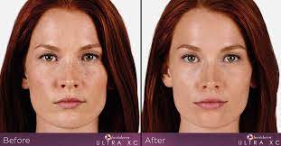 juvederm ultra smile 保质期 before and after