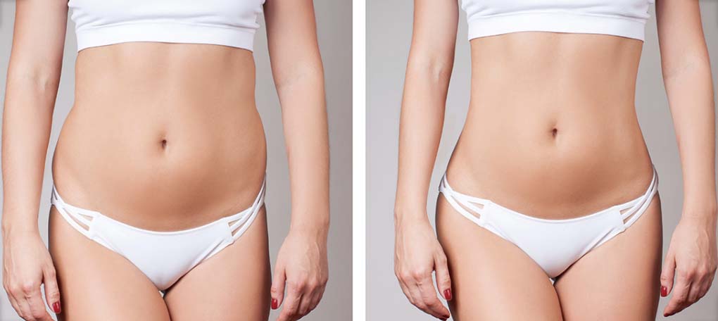 Body Sculpting Inj